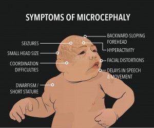 microcéphalie